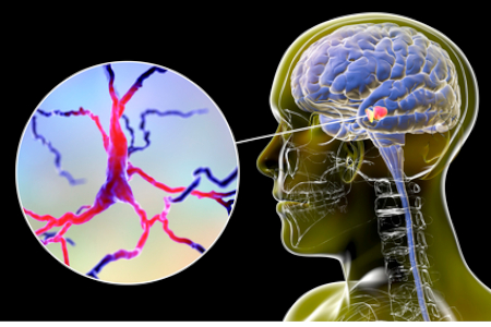 maladie-de-parkinson-ou-en-est-la-recherche-1